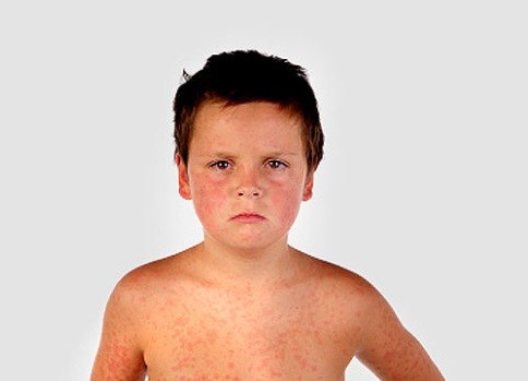 Measles Outbreak: Informing Parents about a Once Dormant Disease Regaining Momentum